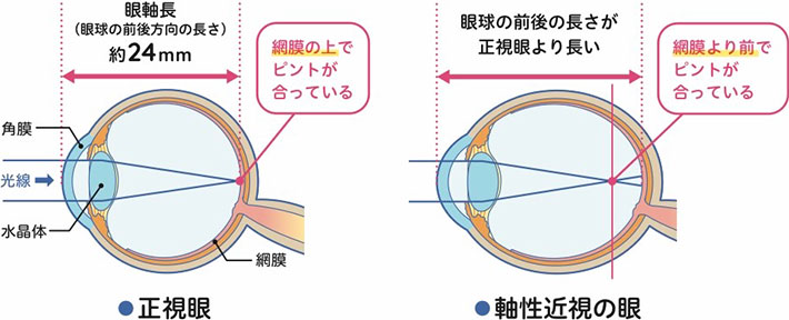 近視とは